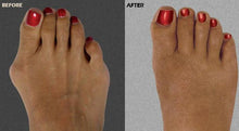 Load image into Gallery viewer, Silicone Hammer Toe Corrector